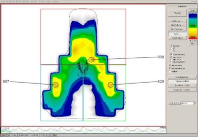 Zusatzpaket bei Sitzbeschwerden: Satteldruckanalyse